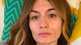 Madame de Rosa muestra los efectos del coronavirus en su piel